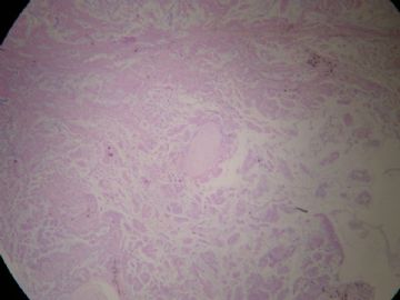 右肺粘液腺癌？粘液型BAC？图2