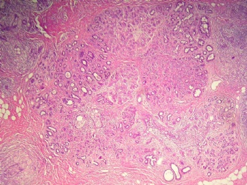乳腺肿物(临床高度疑为恶性)图3
