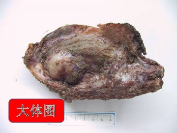 肋骨肿物图1