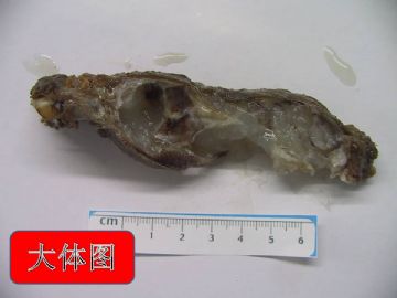 肋骨肿物图3