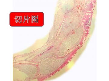 肋骨肿物图4