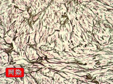 同时发生卵巢肿物，子宫内膜肿物，宫颈原位癌。图36