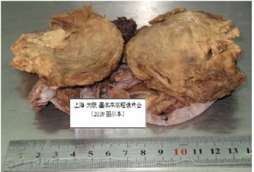 右上纵膈肿块（中-日-澳2009墨尔本病理读片会病例1）图2