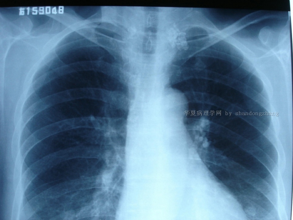 20100123-腹股沟淋巴结转移性恶性肿瘤类型或来源图12