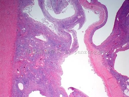Renal mass图1