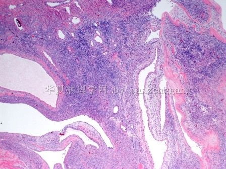 Renal mass图2