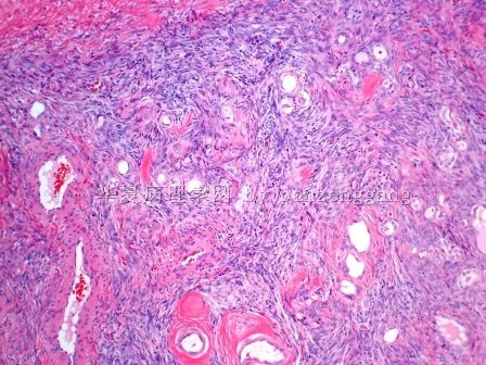Renal mass图3