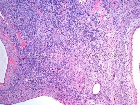 Renal mass图4