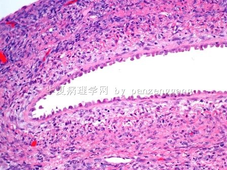 Renal mass图6