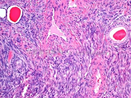 Renal mass图9