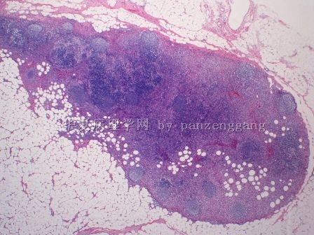 Axillary lymphadenopathy图1