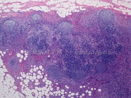 Axillary lymphadenopathy图3