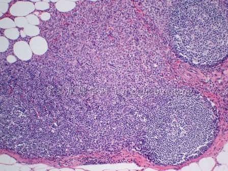 Axillary lymphadenopathy图4