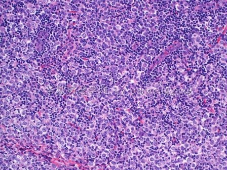 Axillary lymphadenopathy图6