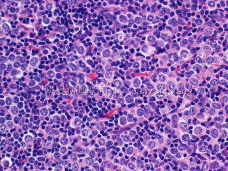 Axillary lymphadenopathy图8
