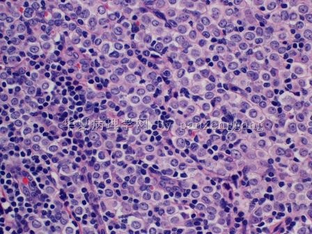 Axillary lymphadenopathy图9