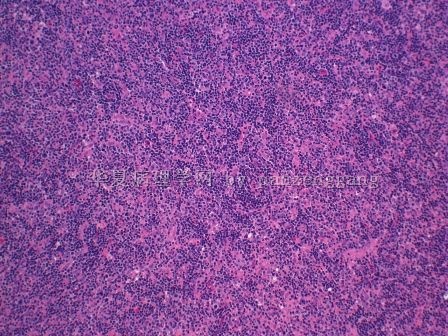 Lymphadenopathy图2