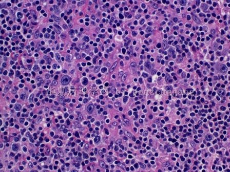 Lymphadenopathy图4