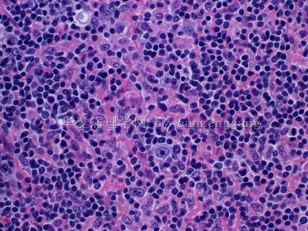 Lymphadenopathy图7