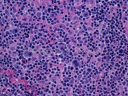 Lymphadenopathy图8