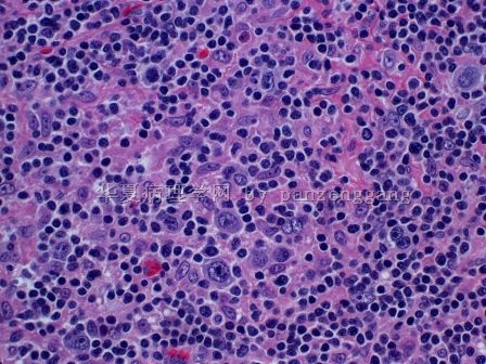 Lymphadenopathy图9