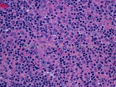 Lymphadenopathy图10