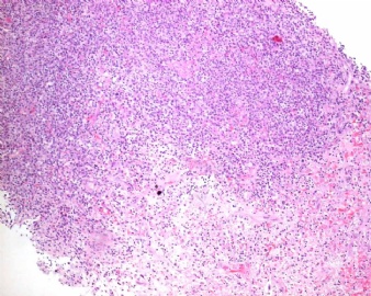 CG216-HIV associated  Polymorphic Lymphoproliferative Disorder图3