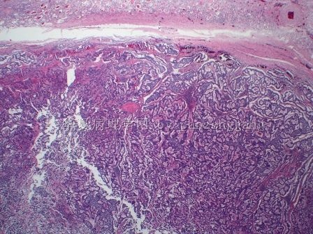 Renal mass图1