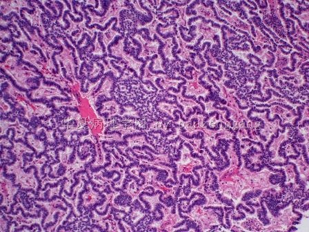 Renal mass图2