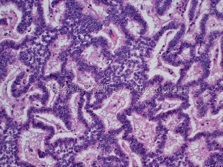 Renal mass图4