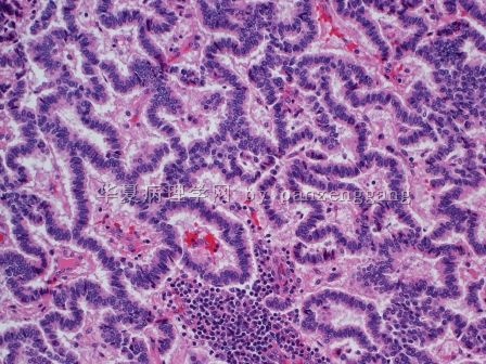 Renal mass图5