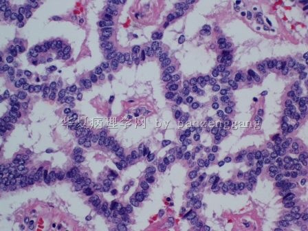 Renal mass图6