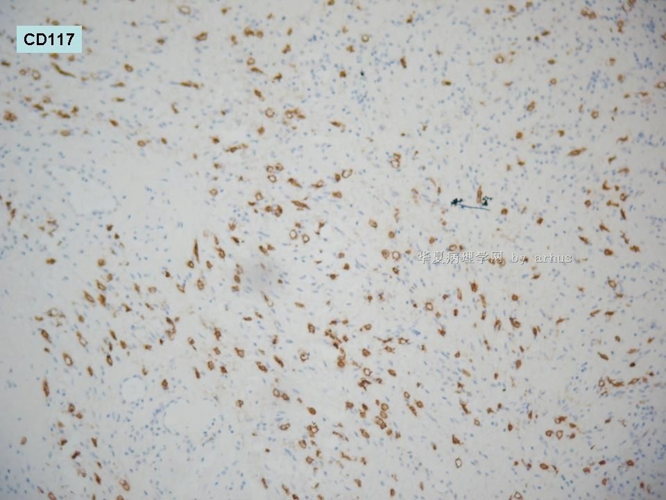 右侧腹股沟肿物-452554图16