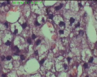 56岁女性腮腺肿物 临床诊断腺淋巴瘤(多数人意见-腺泡细胞癌)图10