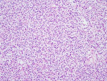 45 year old woman with brain masses图2