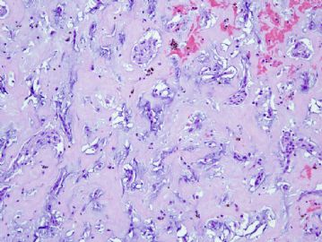 66 year woman with left atrial mass图3