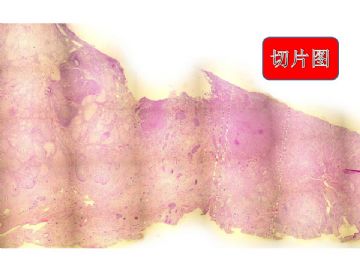 宫颈肿物图5