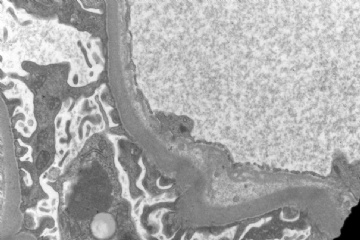 Allograft kidney图4