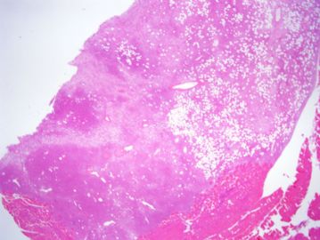 【已确诊】软组织肿瘤-女，42岁，大腿肌肉内软组织肿瘤图1