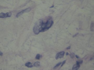 男性乳腺肿物请会诊图4