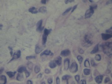 男性乳腺肿物请会诊图5