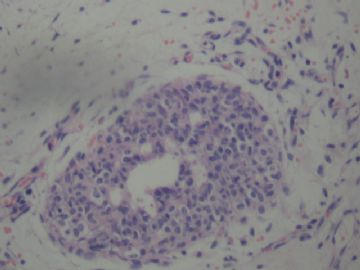男性乳腺肿物请会诊图11