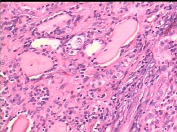 女/78岁 甲状腺肿块 IHC10-4-24图2