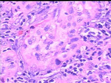 女/78岁 甲状腺肿块 IHC10-4-24图6