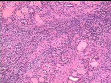 女/78岁 甲状腺肿块 IHC10-4-24图12