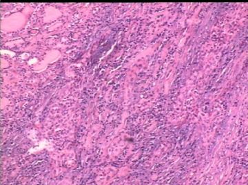 女/78岁 甲状腺肿块 IHC10-4-24图13