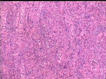 女/78岁 甲状腺肿块 IHC10-4-24图15