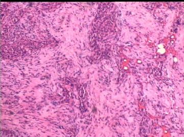 女/78岁 甲状腺肿块 IHC10-4-24图16