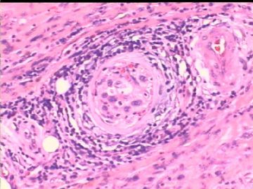 女/78岁 甲状腺肿块 IHC10-4-24图19