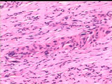女/78岁 甲状腺肿块 IHC10-4-24图22